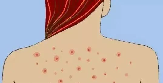 宝宝身上长水猴子怎么破方法来啦快点击收藏